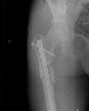 femur removal rod