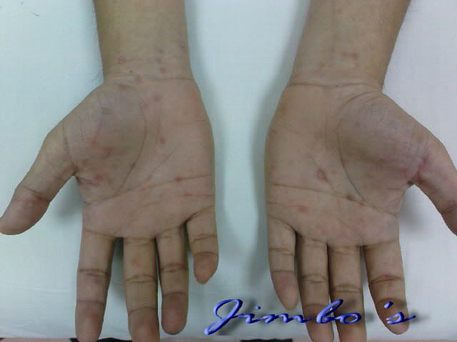 seroconversion rash pictures