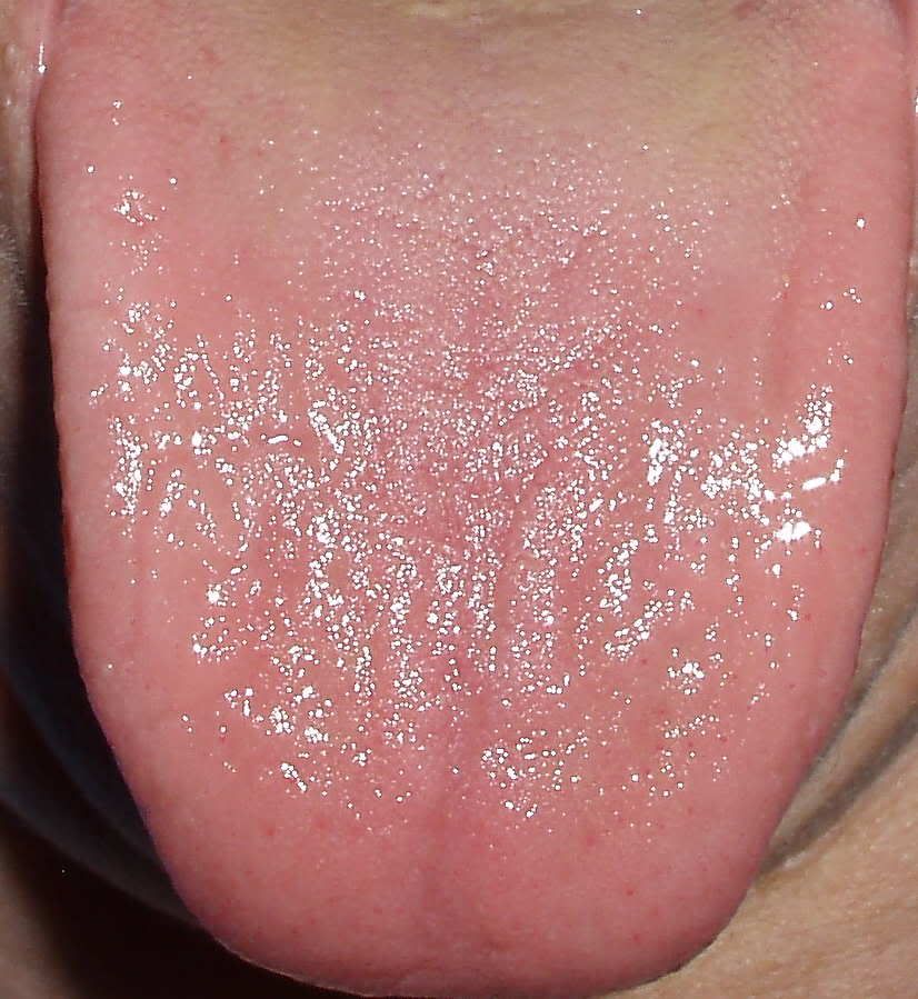 how-to-cure-yeast-infection-on-tongue-best-yeast-infection-tips